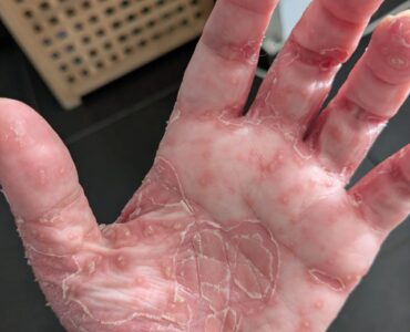 פסוריאזיס בכף יד לפני טיפול