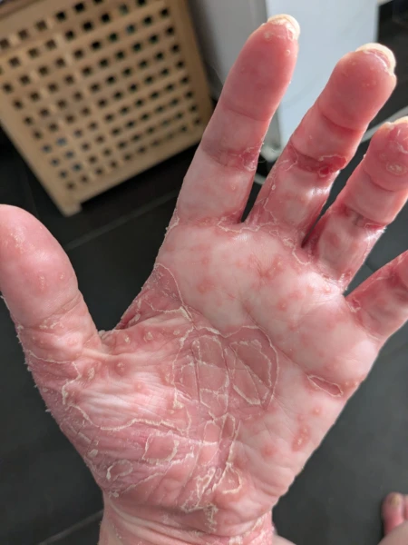 פסוריאזיס בכף יד