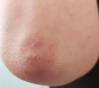 פסוריאזיס במרפק