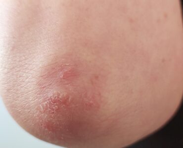 פסוריאזיס במרפק