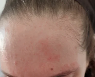 פסוריאזיס בפנים מצח וגבה