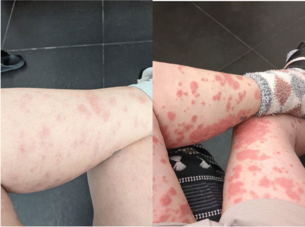 פסוריאזיס ברגליים, לפני ואחרי טיפול