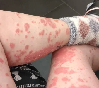 פסוריאזיס ברגליים