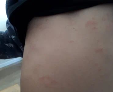 פסוריאזיס אצל ילד בבטן