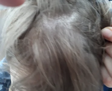 פסוריאזיס בקרקפת של ילד