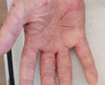 פסוריאזיס בכף יד לפני טיפול