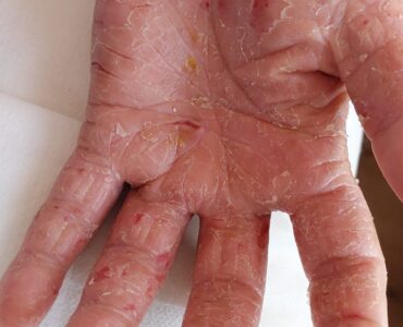 פסוריאזיס בכף יד לפני טיפול