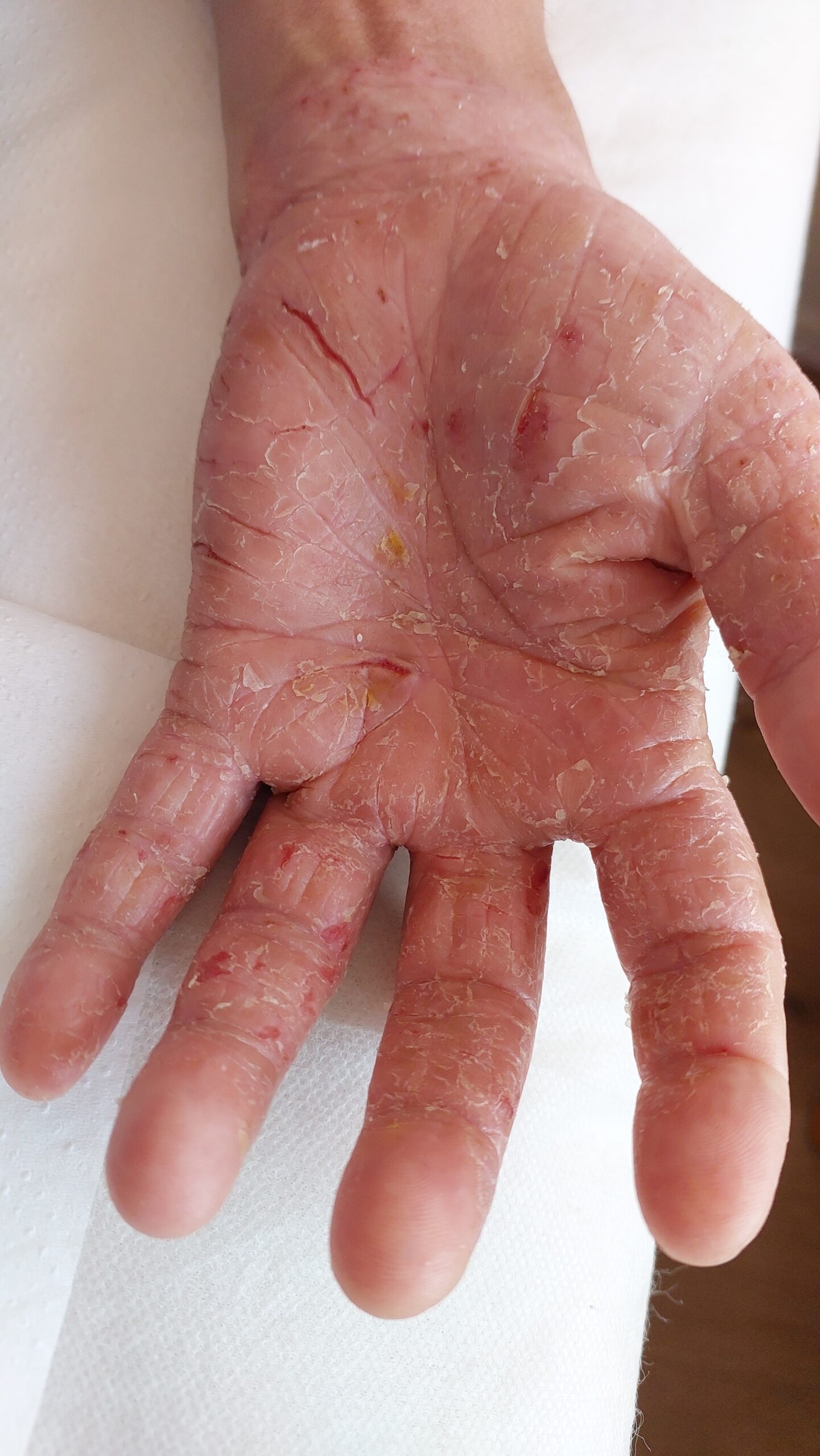 פסוריאזיס בכף יד לפני טיפול