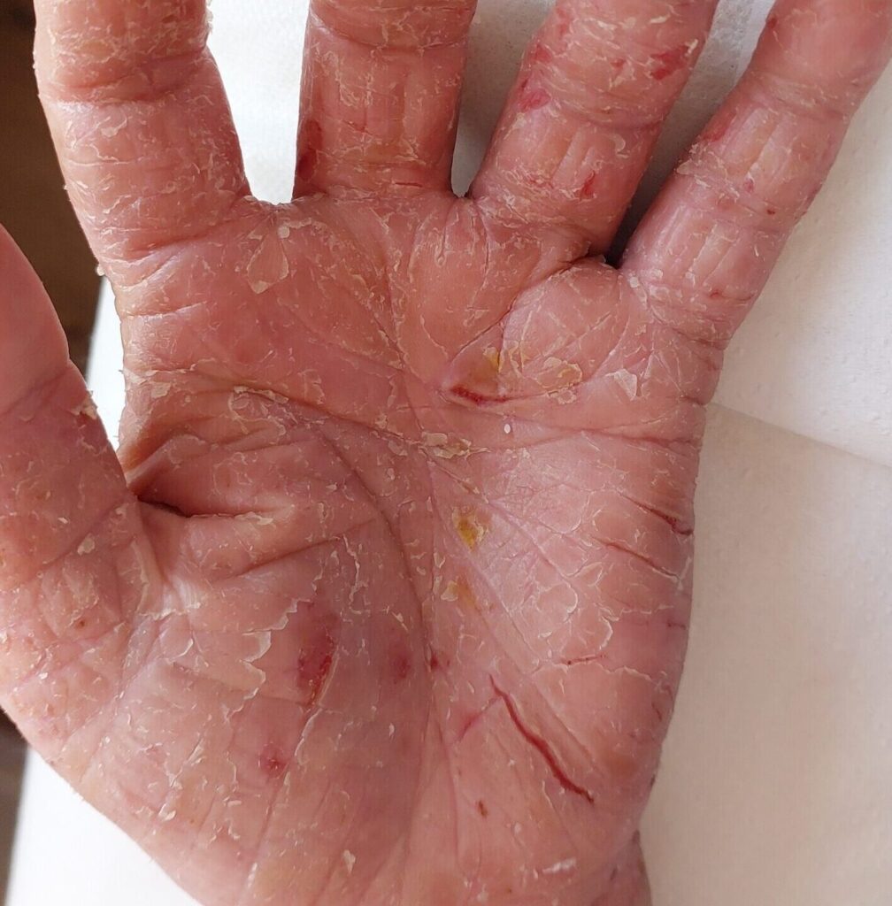 פסוריאזיס בכף יד לפני טיפול