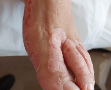 פסוריאזיס בכף הרגל