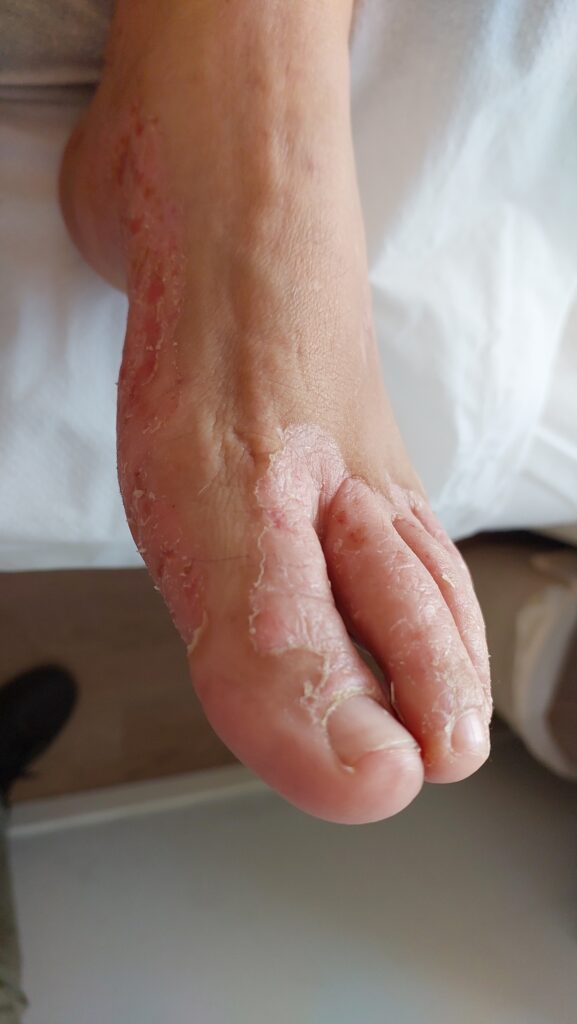 פסוריאזיס בכף הרגל