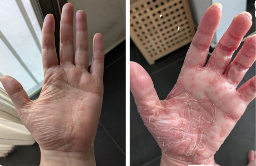 פסוריאזיס ביד - לפני ואחרי טיפול אצל דוד פרלה