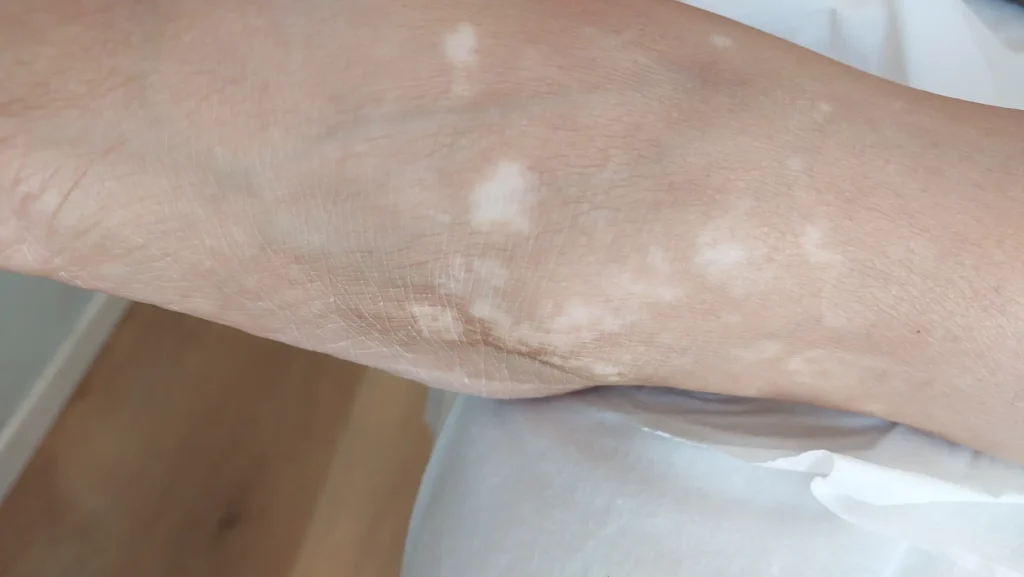 ויטילגו באזור הקרסול