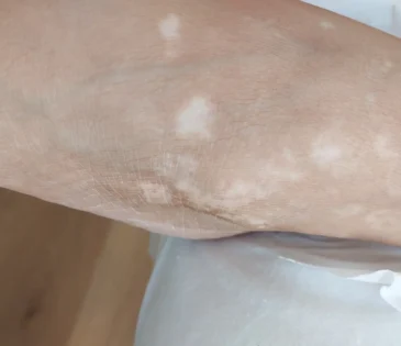 ויטילגו באזור הקרסול