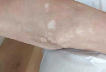 ויטילגו באזור הקרסול