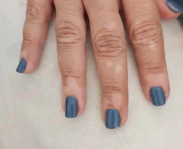 ויטילגו בגב היד