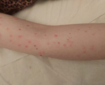 פיטריאזיס רוזיאה בזרוע