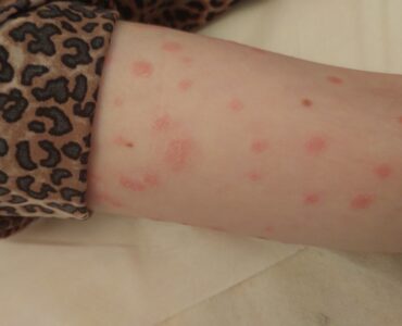 פיטריאזיס רוזיאה זרוע ואמה