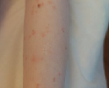 פיטריאזיס רוזיאה ביד