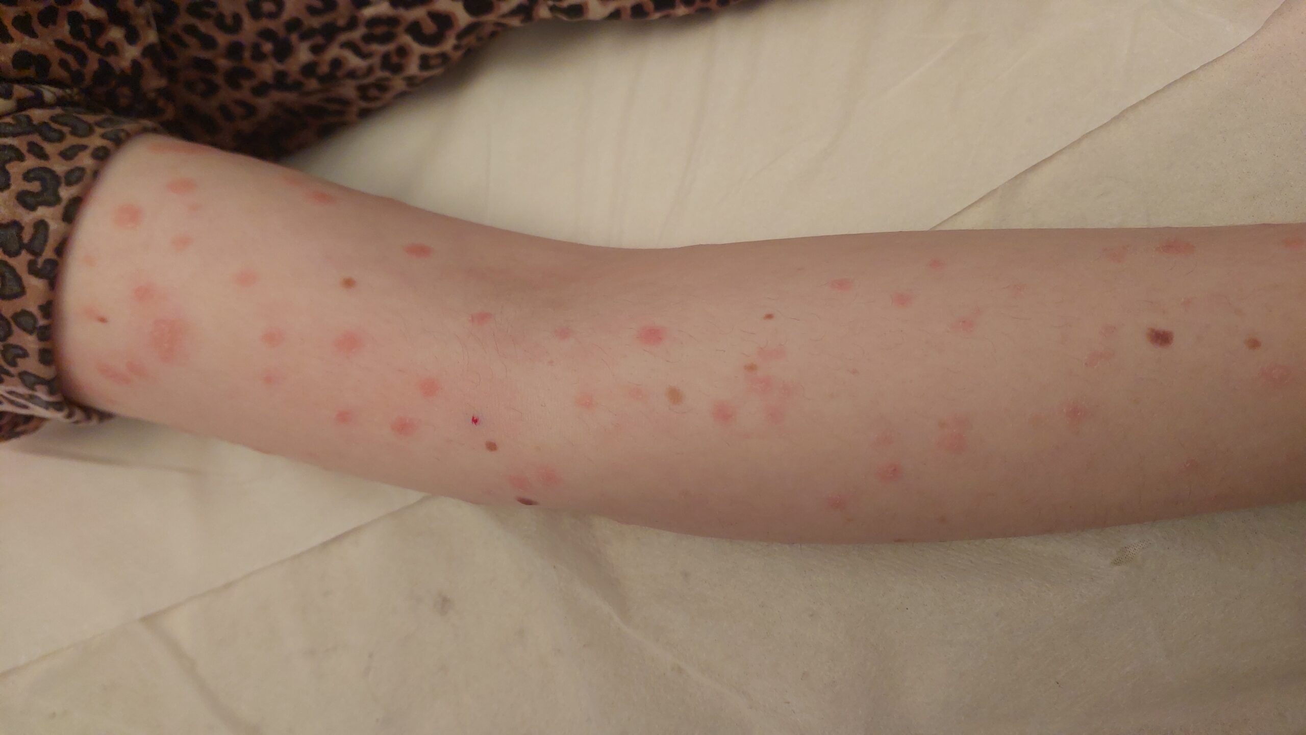 תופעת פיטריאזיס רוזיאה בזרוע