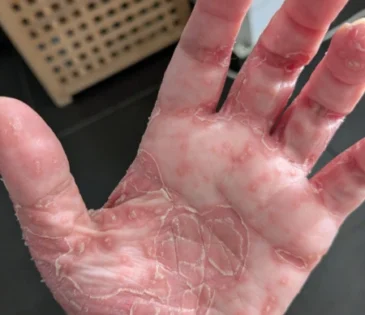 פסוריאזיס בכף יד