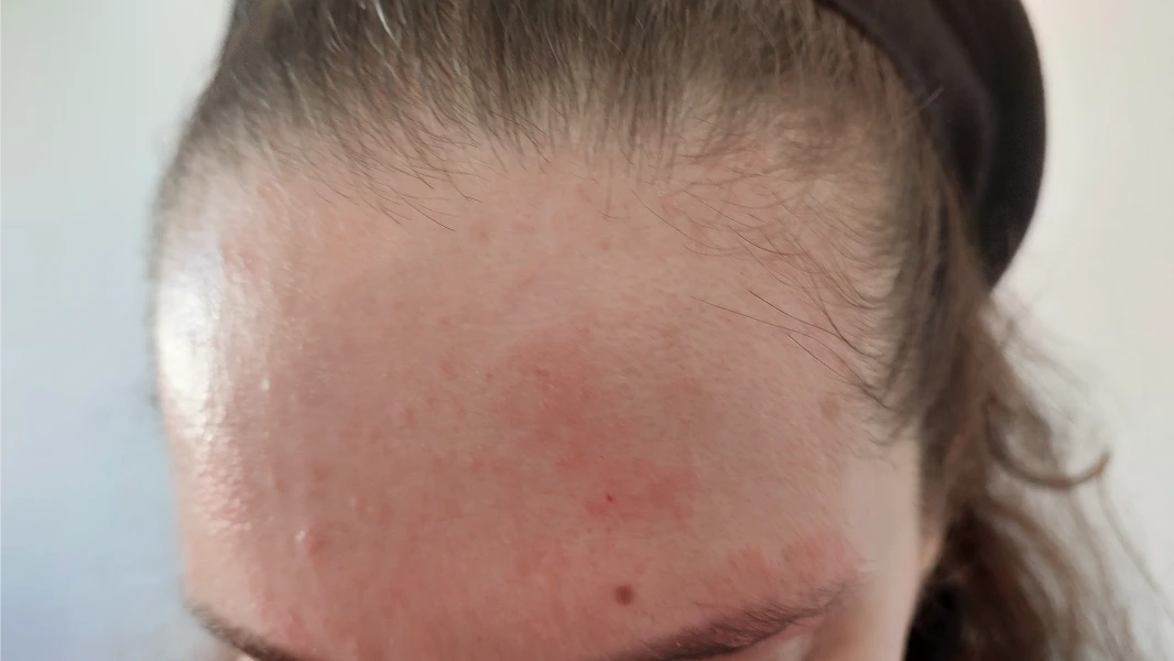 פסוריאזיס בפנים מצח וגבה