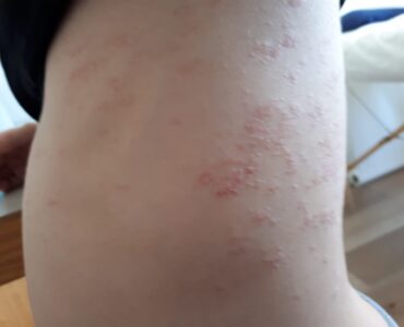 תופעת פיטריאזיס רוזאה בצד הגוף - ילד