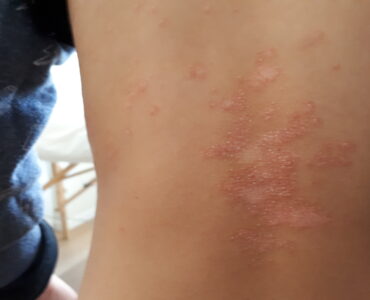 תופעת פיטריאזיס בצד הגוף - ילד 2