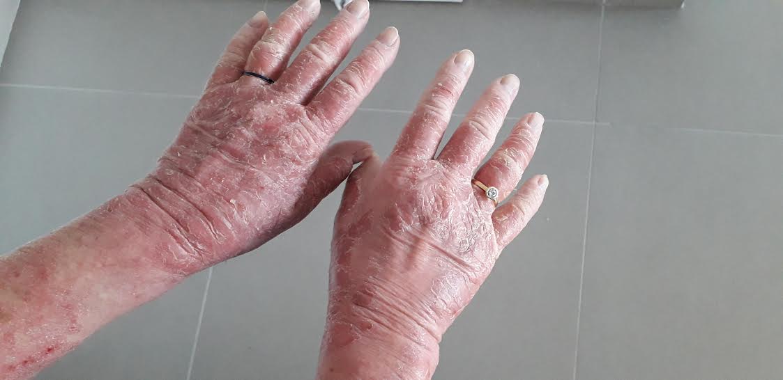 אטופיק ידיים לפני טיפול