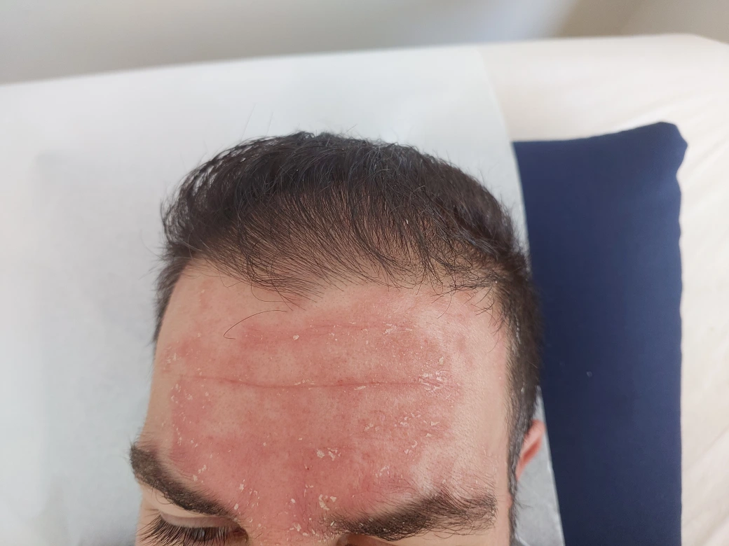 סבוריאה בפנים ובקרקפת