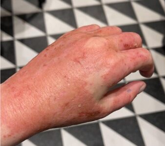 אטופיק דרמטיטיס ביד