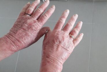 אטופיק ידיים לפני טיפול
