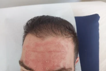 סבוריאה בפנים ובקרקפת